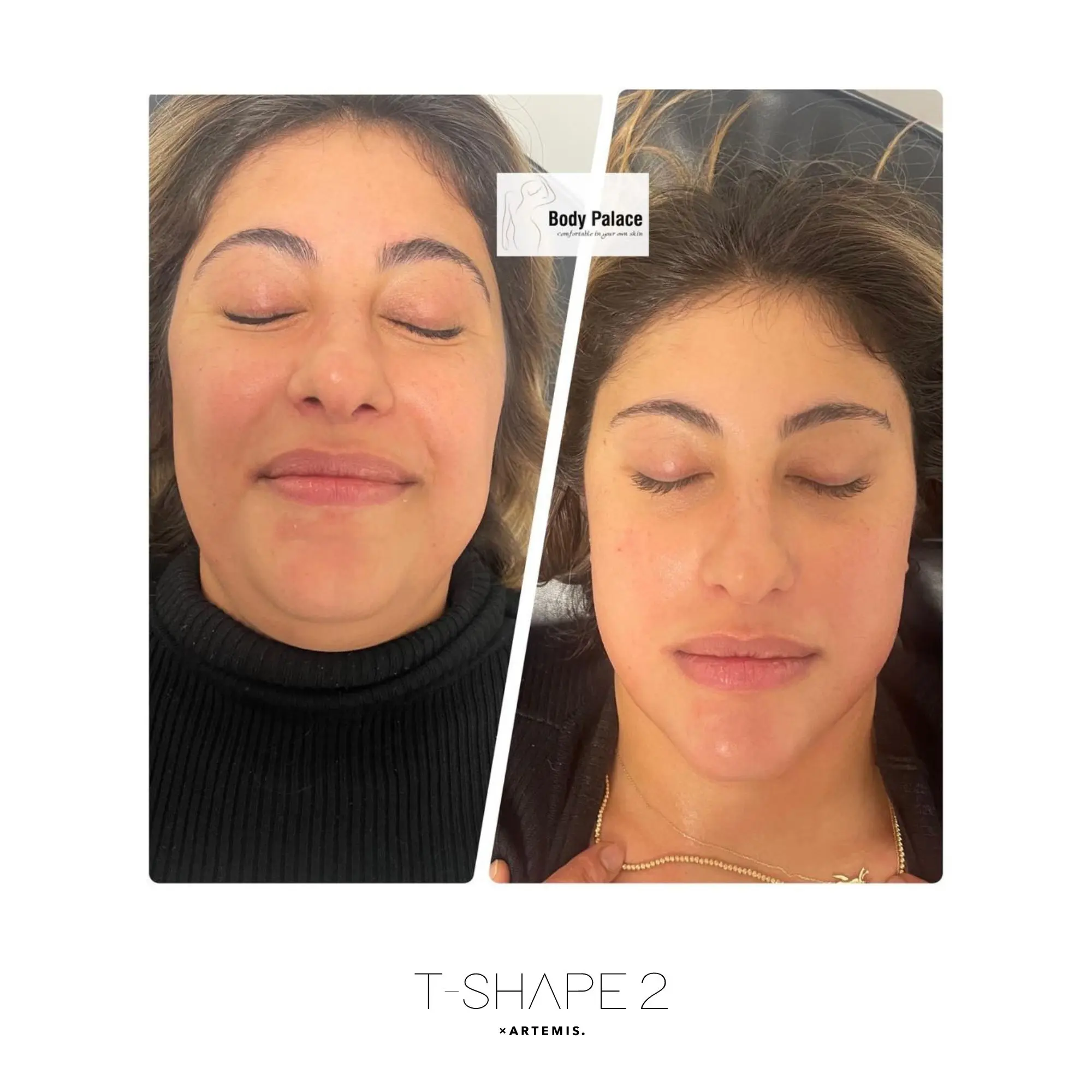 Harmony Hormone Solutions - Side-by-side comparison of a woman's face before (left) and after (right) a cosmetic treatment, showing smoother skin. "Body Palace" and "T-SHAPE 2 ARTEMIS" logos are present.